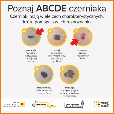 https://www.sp2sroda.pl/files/content/news-lead/abcde_czerniak.png